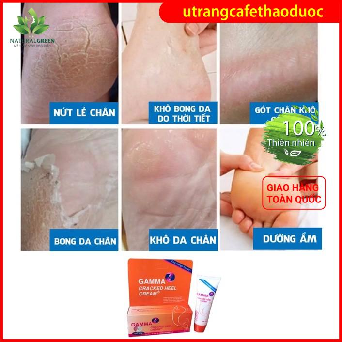 Kem nứt gót chân, tay dành cho da khô, nẻ của Gamma Cracked Heel