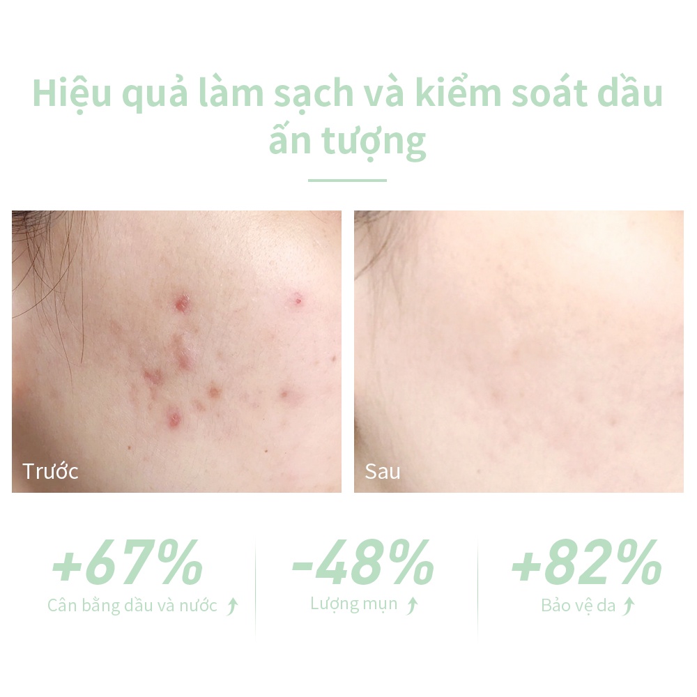 Serum Hỗ trợ giảm mụn Lanbena giảm mụn Dưỡng Ẩm Làm Trắng Kiểm Soát Dầu 30ml