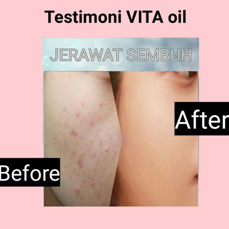 (hàng Mới Về) Kem Trị Sẹo Mụn Vitaoil Hiệu Quả