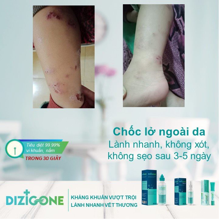 [COMBO] - Dizigone 300ml &amp; Dizigone spray 100ml - kháng khuẩn, rửa vết thương ngoài da