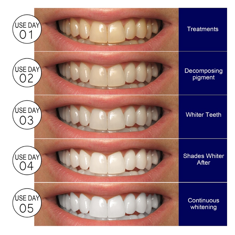 1 Dải Gel Tẩy Trắng Răng Chăm Sóc Răng Miệng