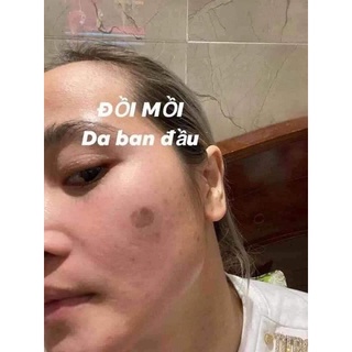 SÉT LẺ TCA CHẤM TÀN NHANG NÁM 35%