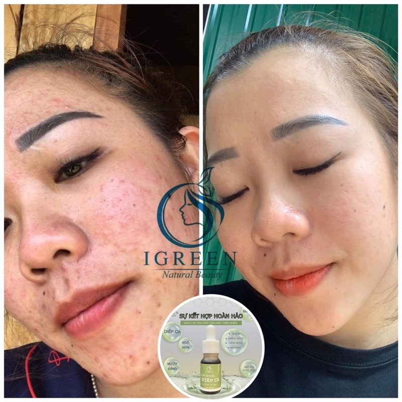 Serum Diếp Cá GIẢM MỤN, GIẢM THÂM, SE KHÍT LỖ CHÂN LÔNG, SÁNG DA - Serum Diếp Cá IGREEN