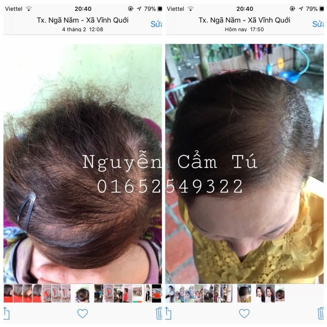 Combo ngăn rụng kích mọc tóc VyvyHairCare