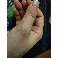 Thảo dược quý Hết Sạch Nấm, Tổ địa, Chàm, Ghẻ Nước, Mụn bóng nước rất ngứa _ Sẵn Có