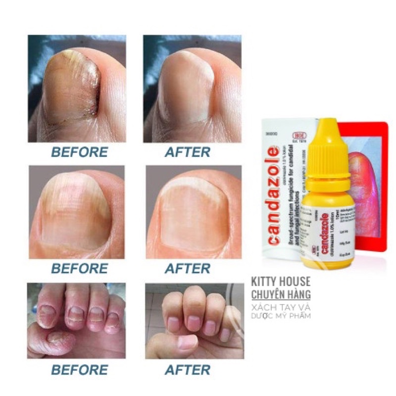 Dung Dịch Loại Bỏ Nấm Móng Tay, Móng Chân Candazole Lotion chai 10ml.
