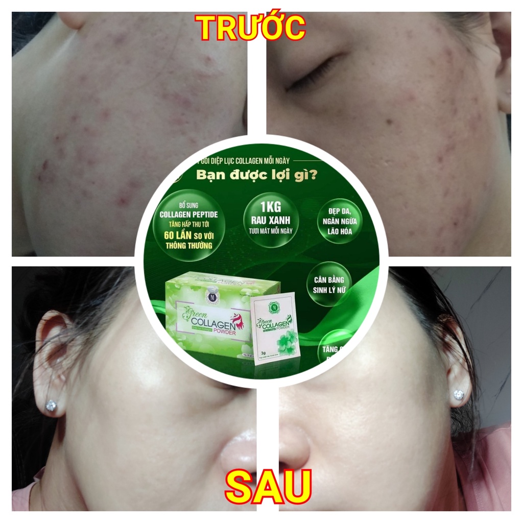 Diệp Lục Collagen Green Family Development Chính Hãng Giúp Đẹp Da, Giảm Táo Bón, Giảm Mụn Nám, Khô Hạn - Hộp 30 gói