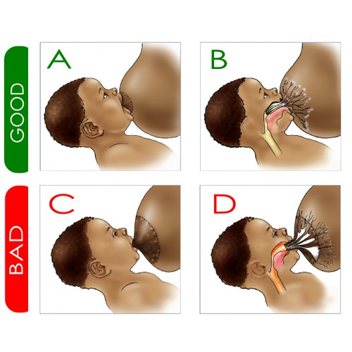 Trợ ti hộp nhựa 2 chiếc, giúp giải quyế nứt cổ gà, núm ti ngắn