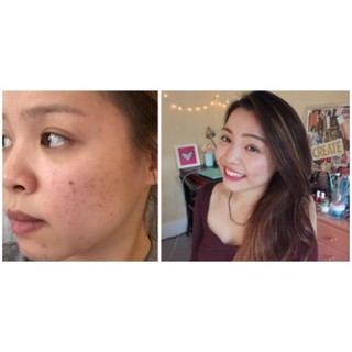 Serum hỗ trợ làm giảm thâm mụn và sáng da MURAD Rapid Age Spot And Pigment Lightening