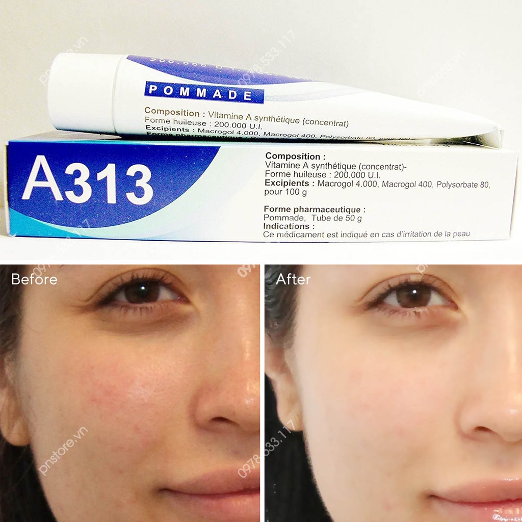 Kem A313 Pommade Retinol 50g Pháp / Kem A313 giảm mụn, xóa mờ vết thâm, giảm vết nhăn và trẻ hóa da hiệu quả