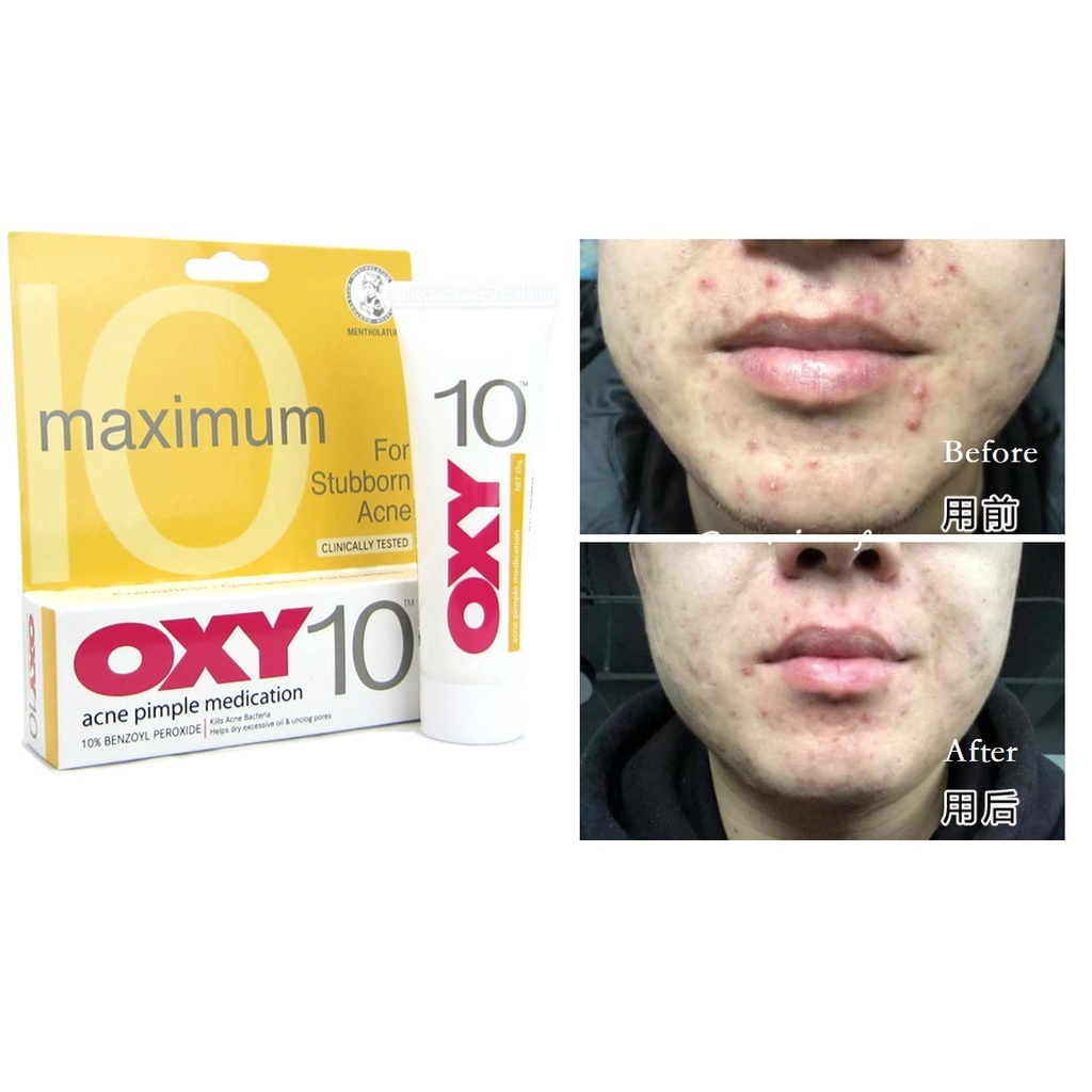 OXY 10 giảm mụn, giảm thâm. Kem chấm mụn Oxy10 Benzoyl Peroxide Malaysia 10g