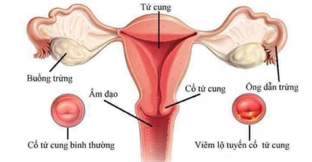 Đặc trị Viêm Lộ Tuyến