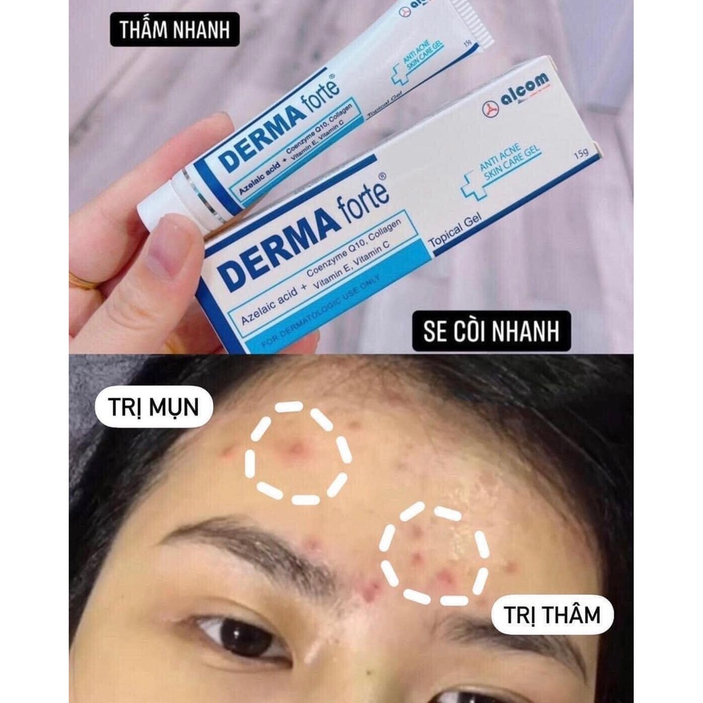 Derma Forte - Kem Ngừa Mụn, Hết Sẹo - Tuýp 15g Cho Mụn Trứng Cá, Đầu Đen, Sạch Bã Nhờn