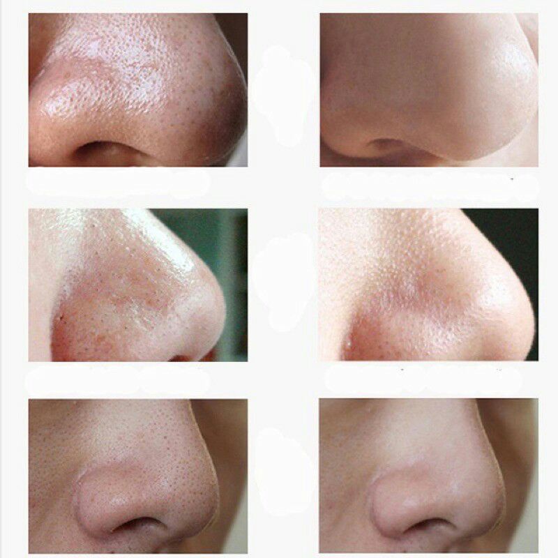 Miếng Gel LỘT MỤN ĐẦU ĐEN THAN TRE HOẠT TÍNH