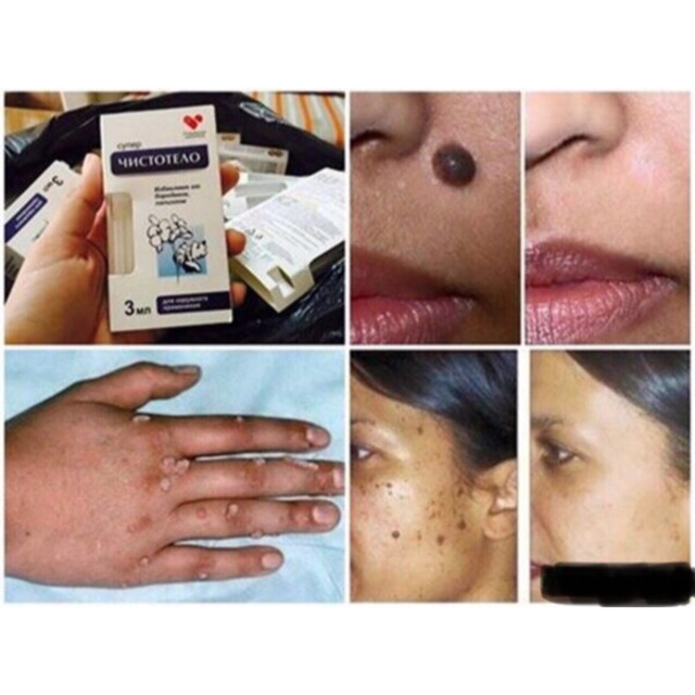 TẨY MỤN CÓC, MỤN RUỒI