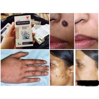 TẨY MỤN CÓC, MỤN RUỒI