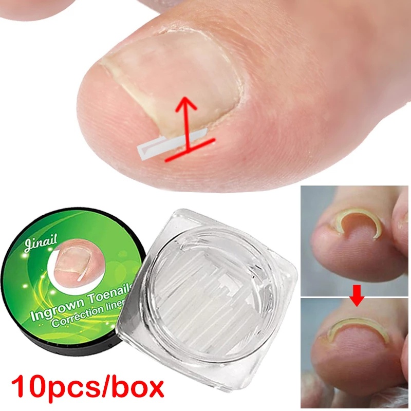Set 10 Dụng Cụ Chỉnh Sửa Móng Chân Mọc Ngược Chuyên Nghiệp