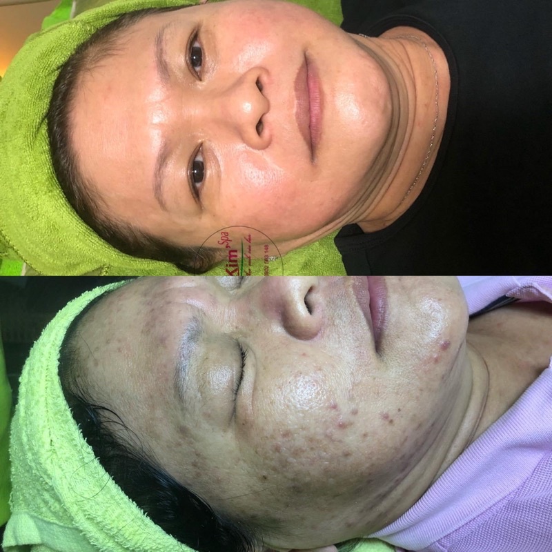 Kem Tái Tạo Da Đông Y Cao Cấp Kim Spa Mụn Nám Tàn Nhang
