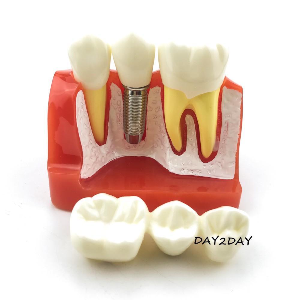 MÔ HÌNH TƯ VẤN SO SÁNH IMPLANT VÀ CẦU RĂNG - MÔ HÌNH TƯ VẤN NHA KHOA - MẪU HÀM 2017