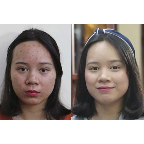 Serum giảm mụn, giảm thâm DR.LAVIC STEP 2: ANTI ACNE SERUM - Serum mụn số 3 Dr.lavic