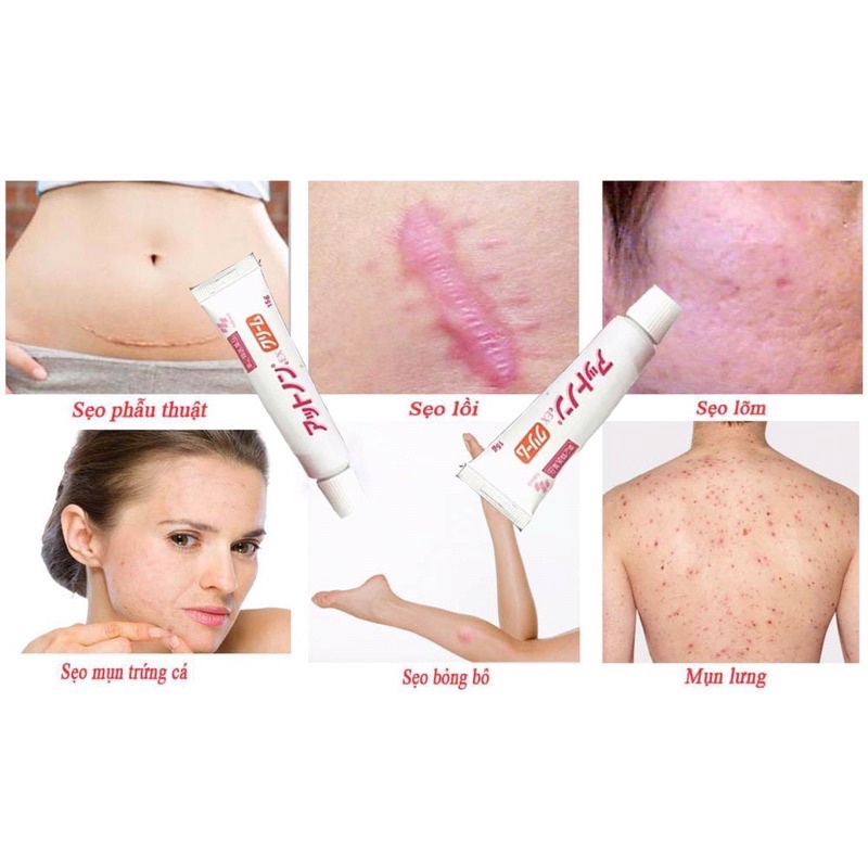 Kem bôi giúp làm mơ sẹo  Attonon Kobayashi 10g - 15g Nhật Bản | BigBuy360 - bigbuy360.vn