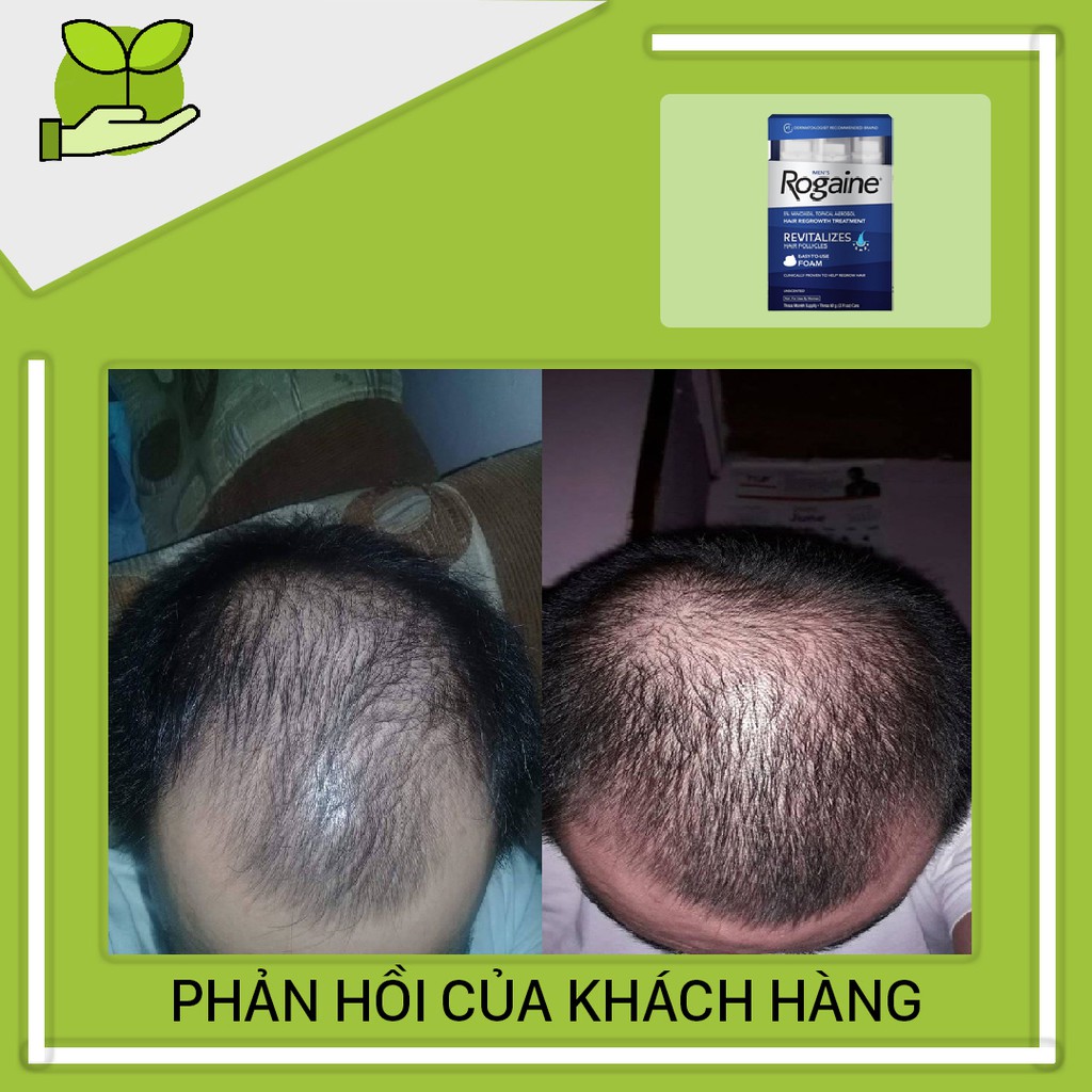 Minoxidil 5% Dạng Bọt Mọc Râu Tóc Rogaine Mỹ Combo 3 Lọ