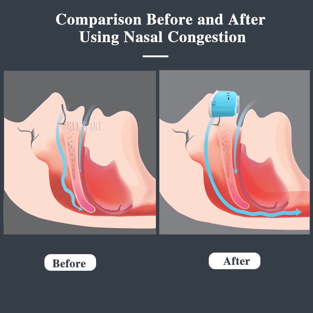 Thiết Bị Chống Ngáy Bằng Điện Hỗ Trợ Cải Thiện Giấc Ngủ
