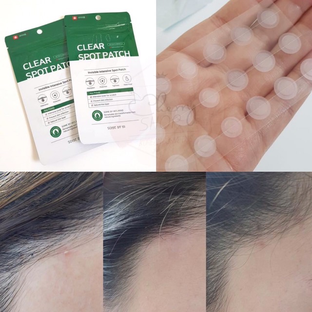 💥🍒Miếng Dán Mụn Some By Mi Clear Spot Patch