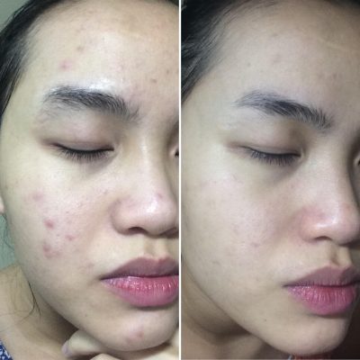 Serum Giảm Mụn, Mờ Thâm, Thông thoáng lỗ chân lông SVR Sebiaclear 30ml