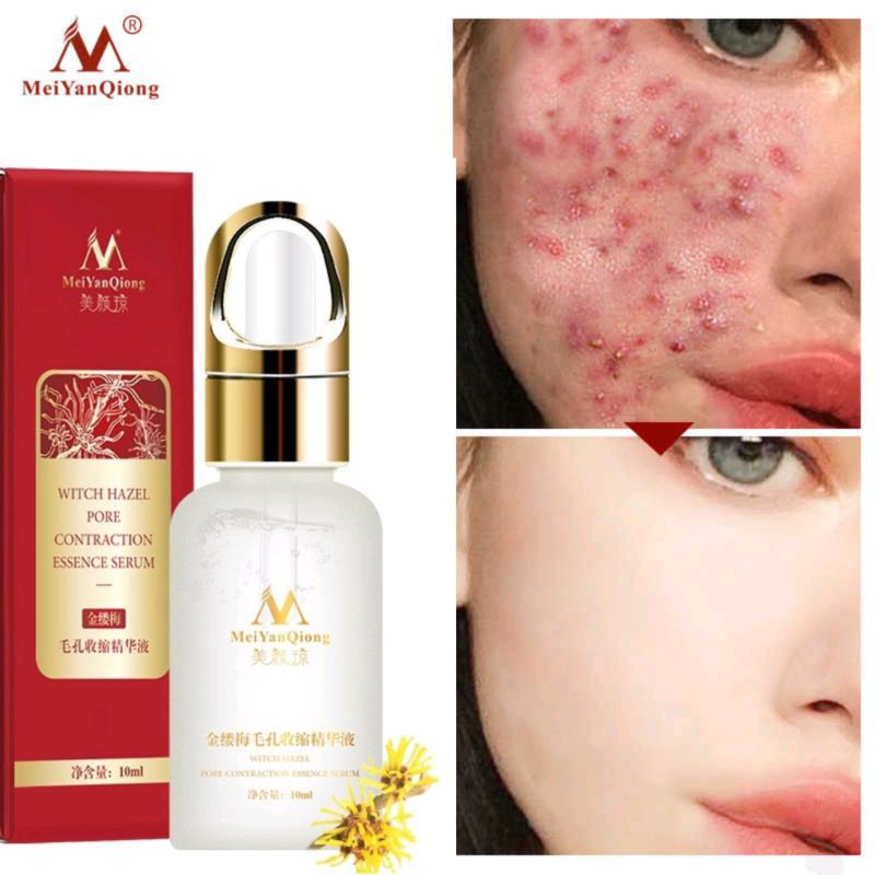 Serum Hết Mụn Se Khích Lỗ Chân Lông Trắng Da