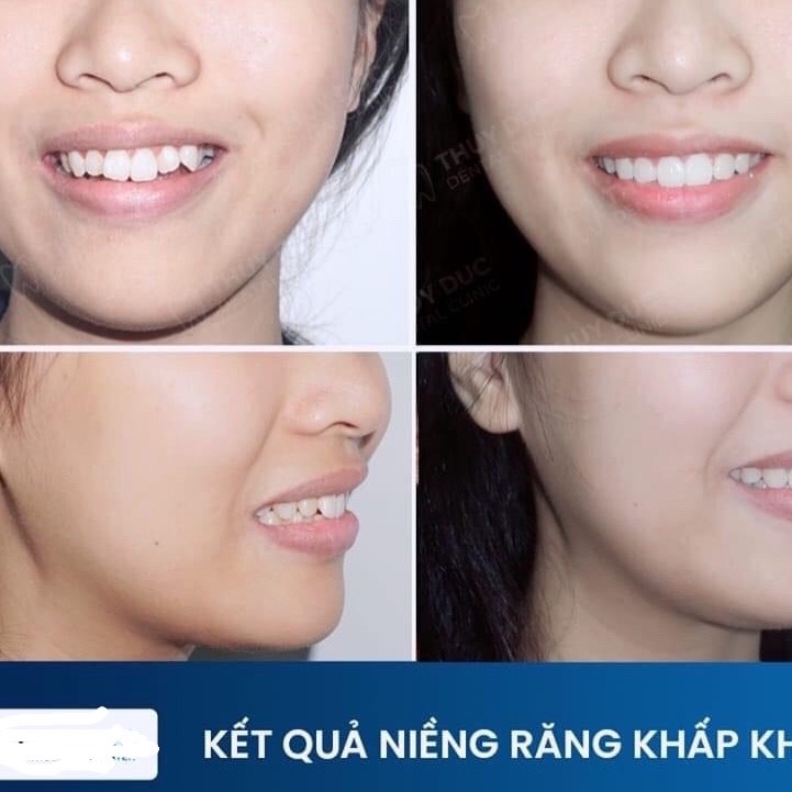 Bộ niềng răng trainer tại nhà,niềng răng silicon cho răng khấp khểnh