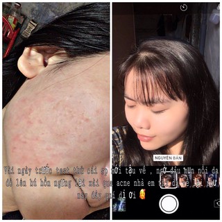 Kem Acne Mỹ Lyn