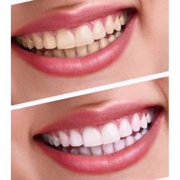 KEM ĐÁNH RĂNG MEDIAN 93%