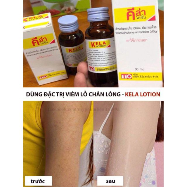 Kela Lotion - Giảm Viêm Lỗ Chân Lông 80% | BigBuy360 - bigbuy360.vn