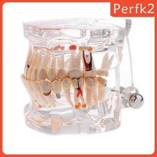 2x Human Mouth Dental Teeth Pathological Model Teaching Study Tools Clear