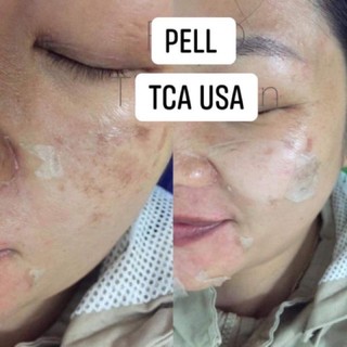 Peel da TCA USA chuyên dành cho thâm nám tàn nhang