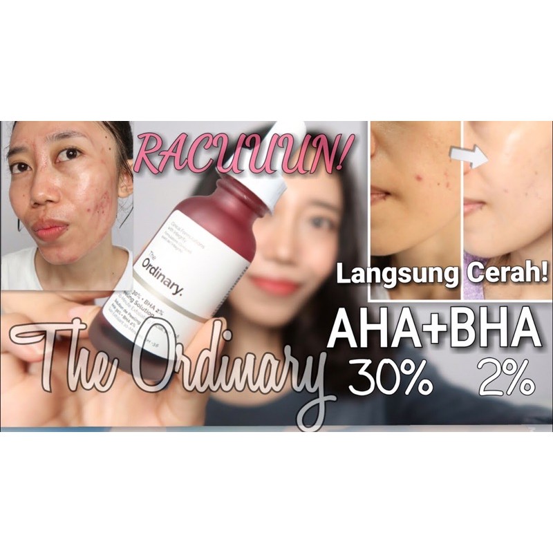 Tinh chất peel tẩy da chết THE ORDINARY AHA 30% + BHA 2% PEELING SOLUTION