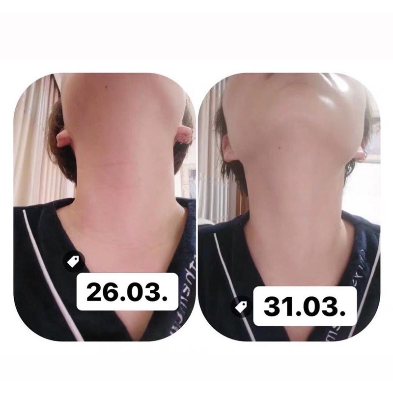 KEM DƯỠNG DÀNH CHO CỔ NAITE THREAD NECK CREAM MEDI PEEL