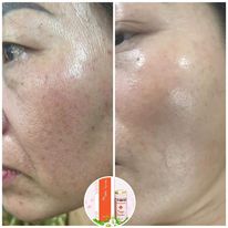 Ủ Nano Tảo Sinh Học Nano Spirulina Fourets Cosmetics, Đánh Bay Nám Mảng, Giảm Thâm, Thu Nhỏ Lỗ Chân Lông - 5 ml