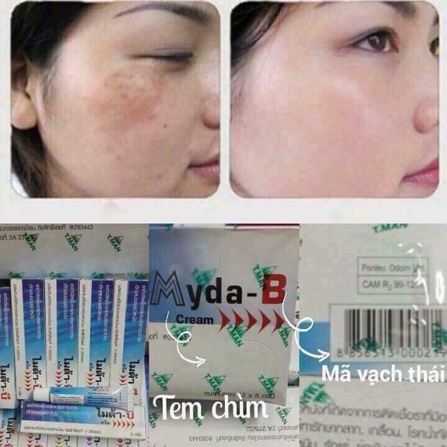 Kem loại bỏ nám, lang ben, đồi mồi Myda-B