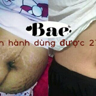  Tinh Dầu trị rạn da
