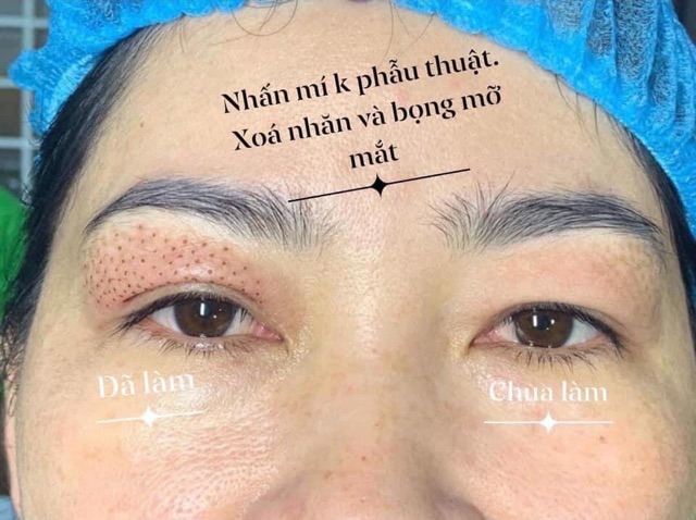 Máy PLASMA nhấn mí, giảm rạn da, chống nhăn