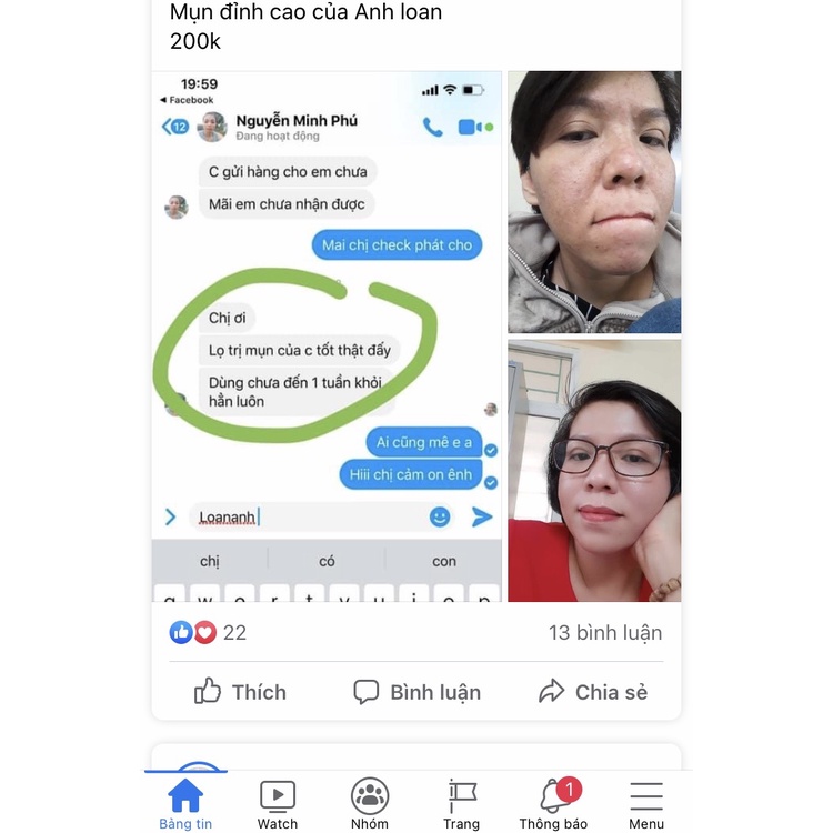 Serum giảm mụn, thâm rỗ Anh Loan 5ml | BigBuy360 - bigbuy360.vn