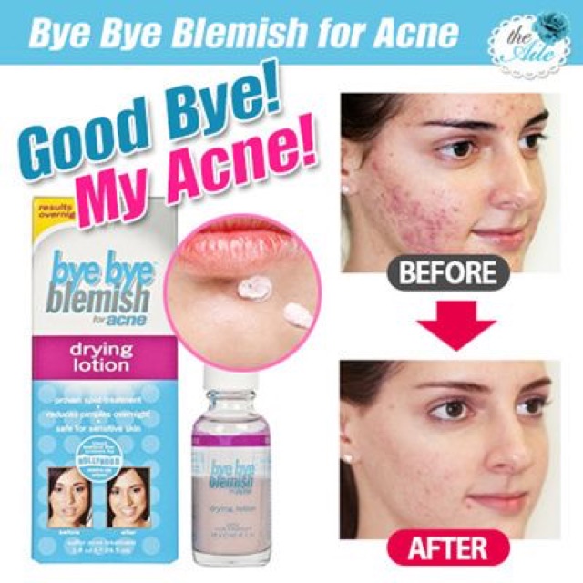 Dung Dịch Chấm Xẹp Mụn Sưng Cấp Tốc Bye Bye Blemish Drying Lotion