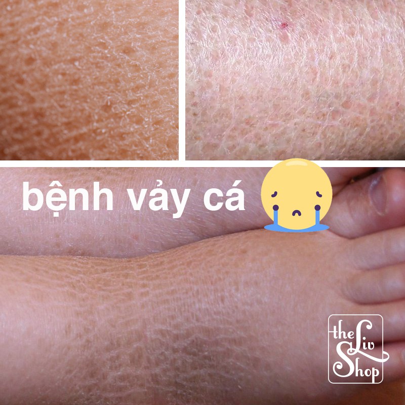 Da vảy cá, da rắn -  Kem dưỡng da đặc biệt homemade