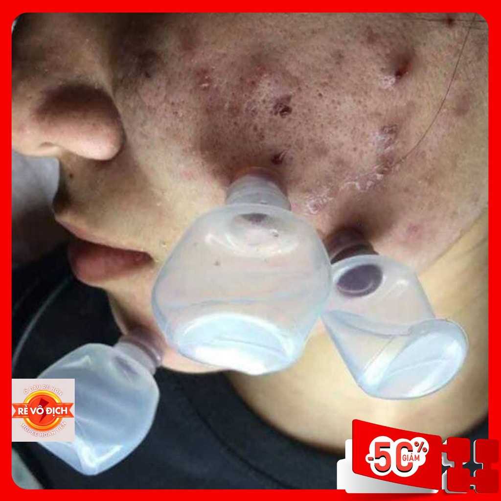 Ống nhựa hút máu bầm | combo 100 ông hút máu bầm