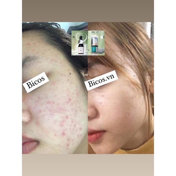 Cao Đen Kiềm Dầu Ngừa Viêm Chính Hãng BICOS 30ml