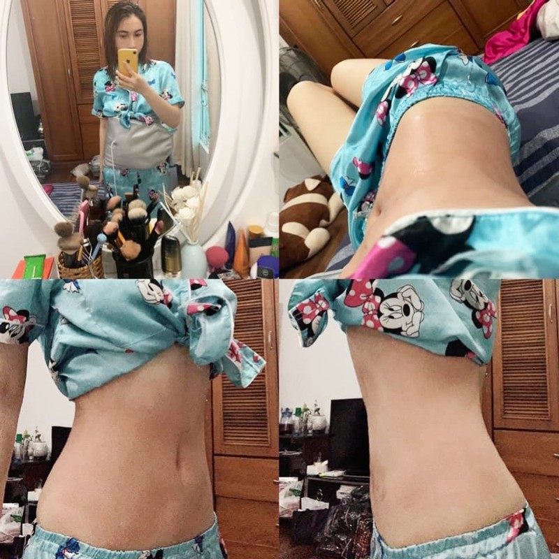 Đai Quấn Nóng Giảm Béo Bụng Kết Hợp RUNG 3 Cấp Độ Làm TAN MỠ BỤNG - Thẩm Mỹ Huyền Trang NANOCEE