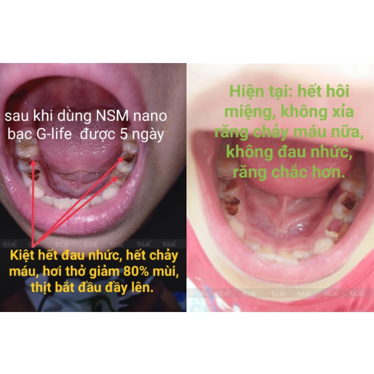 Nước Súc Miệng Nano Bạc Green Cool  Ngăn Ngừa Hôi Miệng và chảy máu chân răng