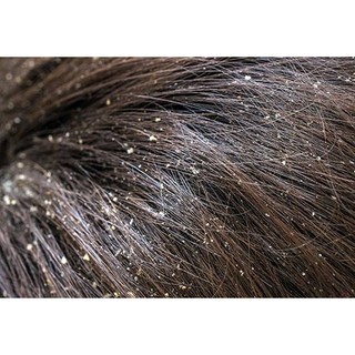 TRỊ GÀU - TRỊ NẤM ĐẦU HAIR FUN